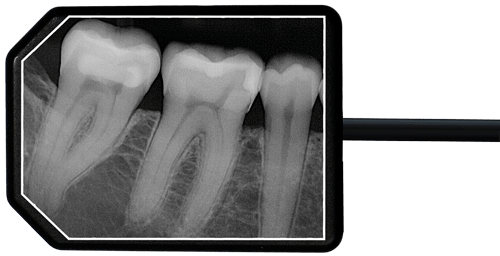 Apex-Dental-Sensors-Size2-Xray