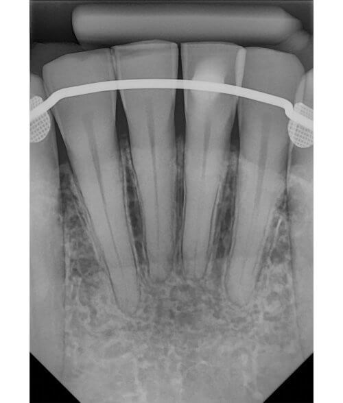 DC-Air-Wireless-Dental-Sensor-Sample-Xray-Anterior-Product