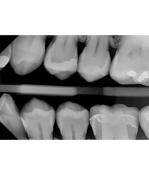 DC-Air-Wireless-Dental-Sensor-Sample-Xray-BWX-Product