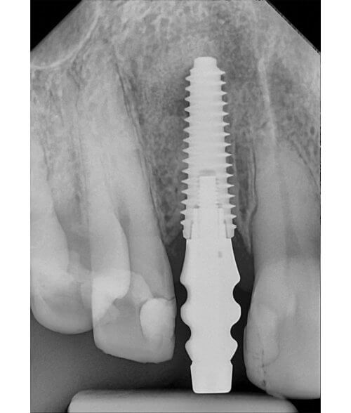 DC-Air-Wireless-Dental-Sensor-Sample-Xray-Implant-Product