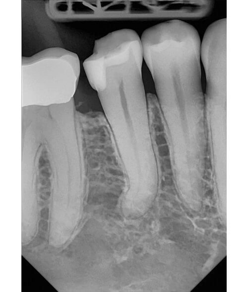 DC-Air-Wireless-Dental-Sensor-Sample-Xray-Vertical-PA-Product